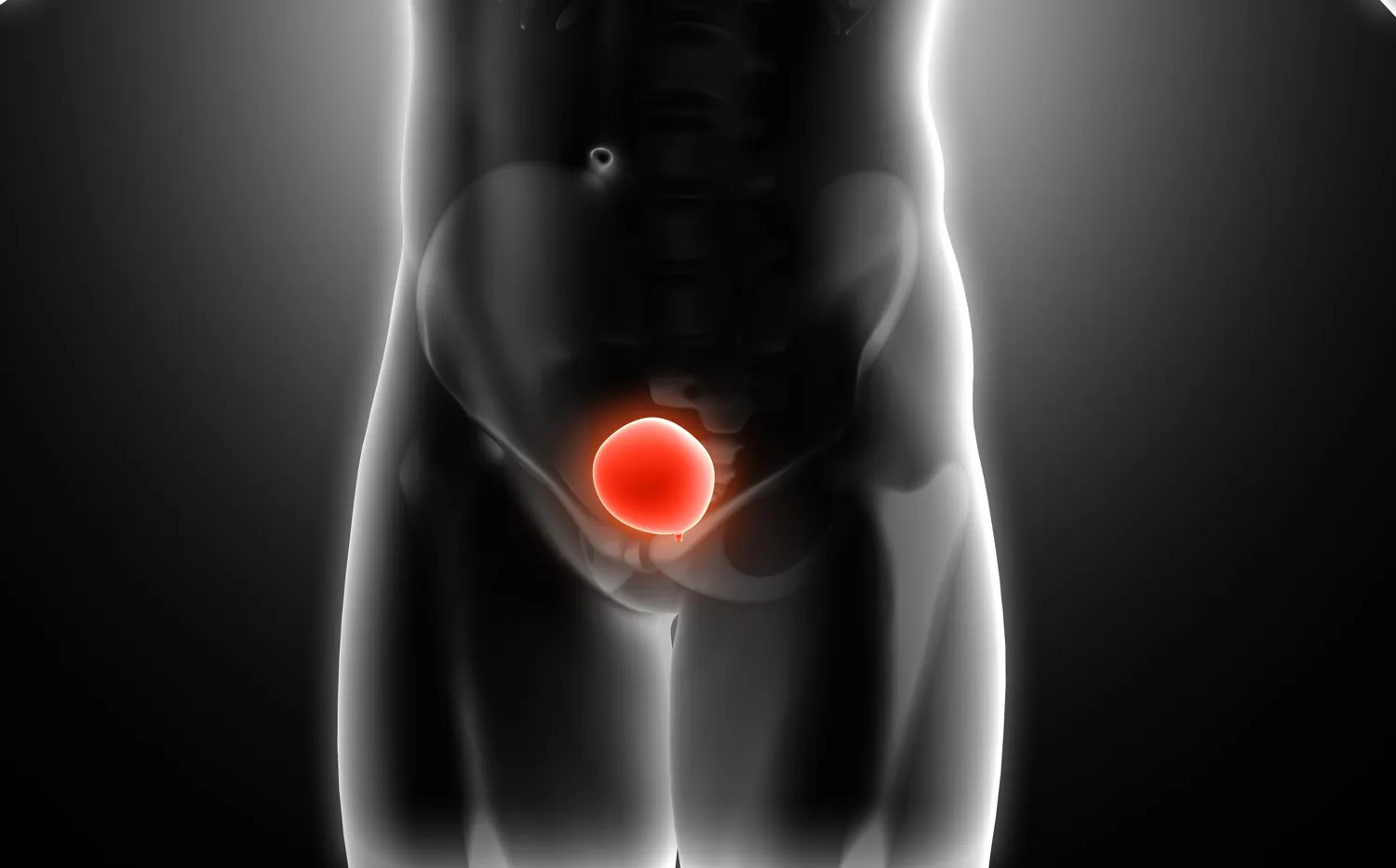 El cáncer de vejiga: el enemigo silencioso que aún pasa desapercibido