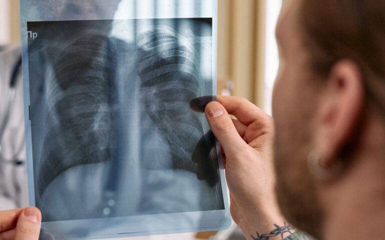 IA-cancer-pulmon-27082025