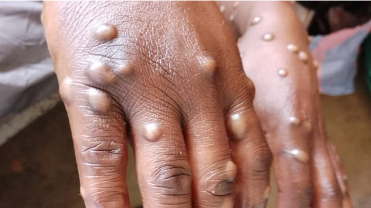 Mpox deja de ser emergencia mundial, confirma la OMS